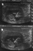 BabyPickle