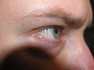 <img300*0:stuff/Eye_from_side.jpg>