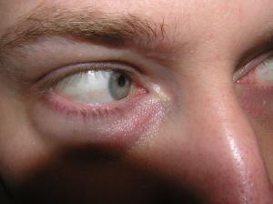 <img300*0:stuff/Eye_looking_to_the_nose-side.jpg>
