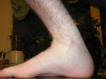 <img150*0:stuff/Foot_bent_backwards.jpg>