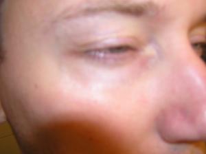 <img300*0:stuff/Sleepy_eye.jpg>