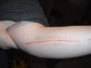 Arm Injuy
